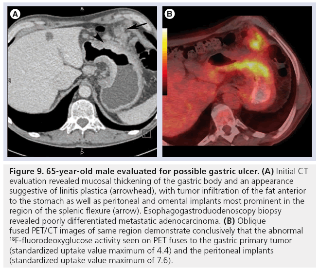 imaging-in-medicine-gastric-ulcer