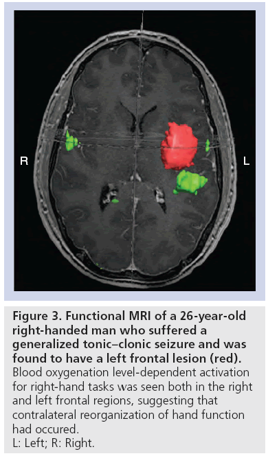 imaging-in-medicine-generalized-tonic