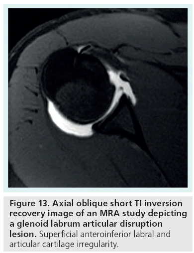 imaging-in-medicine-glenoid-labrum