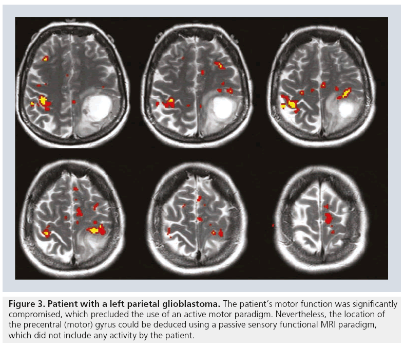 imaging-in-medicine-glioblastoma