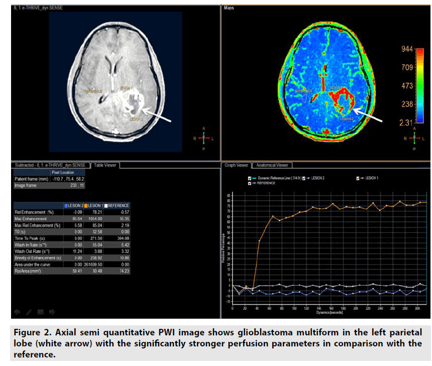 imaging-in-medicine-glioblastoma-multiform