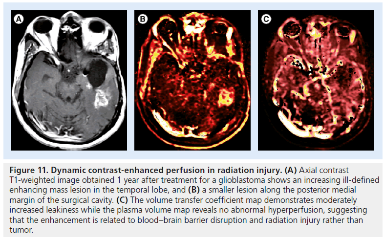 imaging-in-medicine-glioblastoma-shows