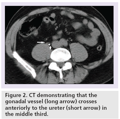 imaging-in-medicine-gonadal-vessel