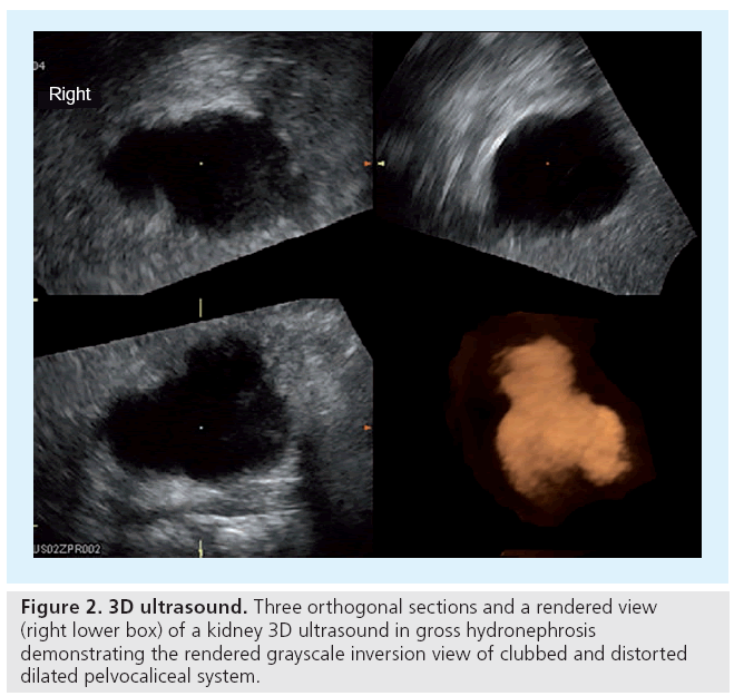 imaging-in-medicine-gross-hydronephrosis