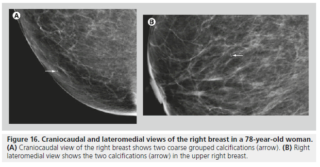 imaging-in-medicine-grouped-calcifications