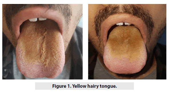 imaging-in-medicine-hairy-tongue