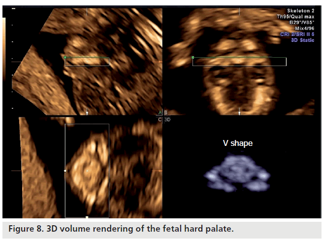 imaging-in-medicine-hard-palate