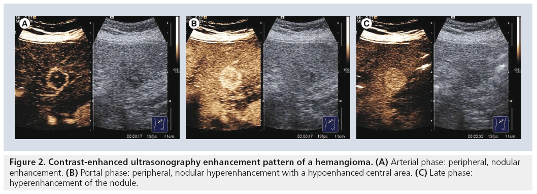imaging-in-medicine-hemangioma