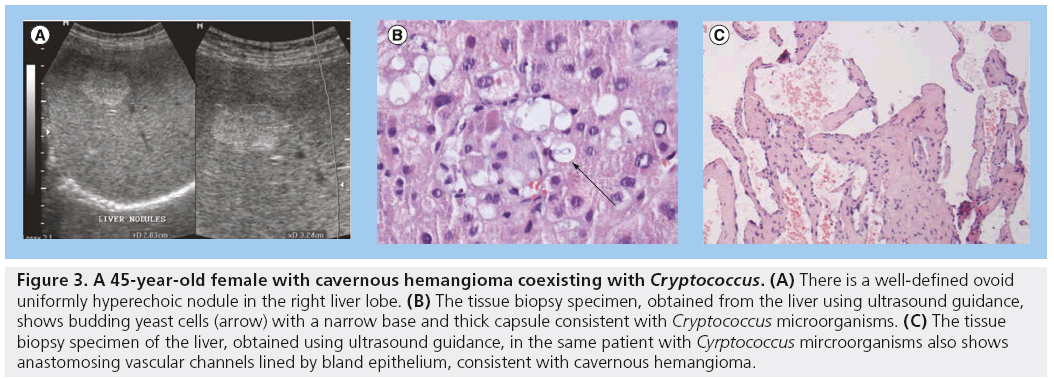 imaging-in-medicine-hemangioma-coexisting