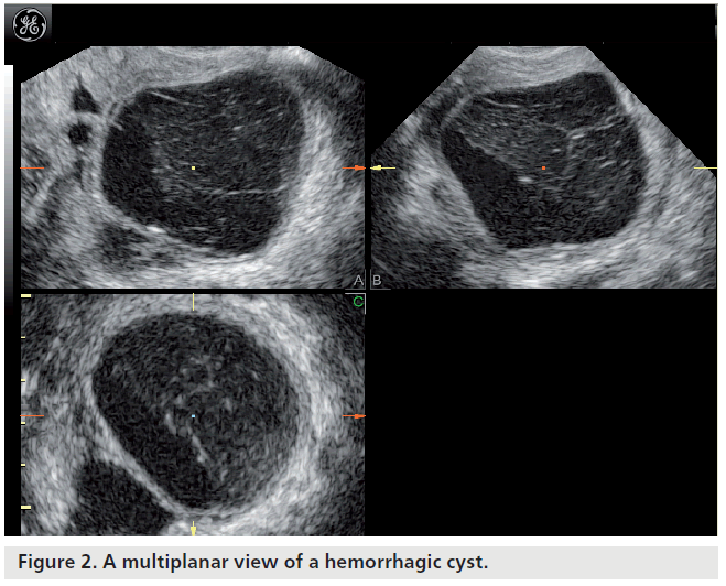 imaging-in-medicine-hemorrhagic-cyst
