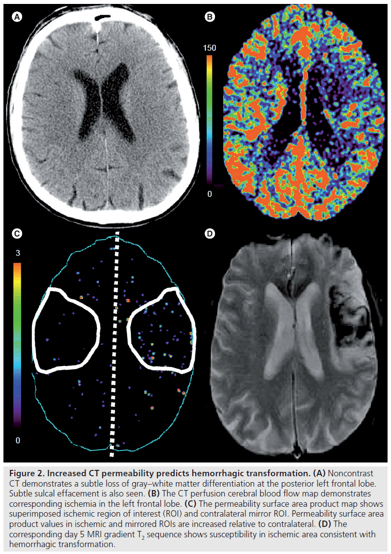 imaging-in-medicine-hemorrhagic-transformation