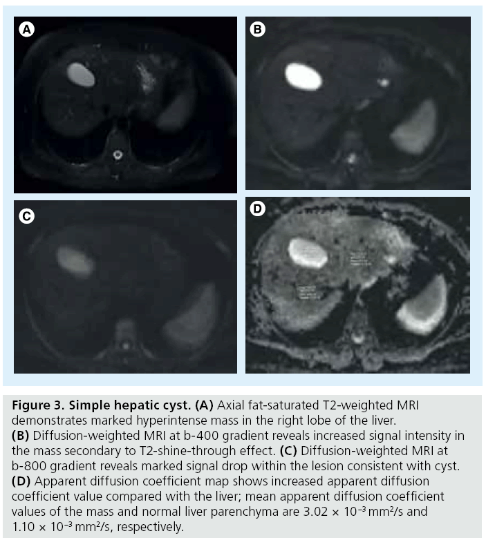 imaging-in-medicine-hepatic-cyst