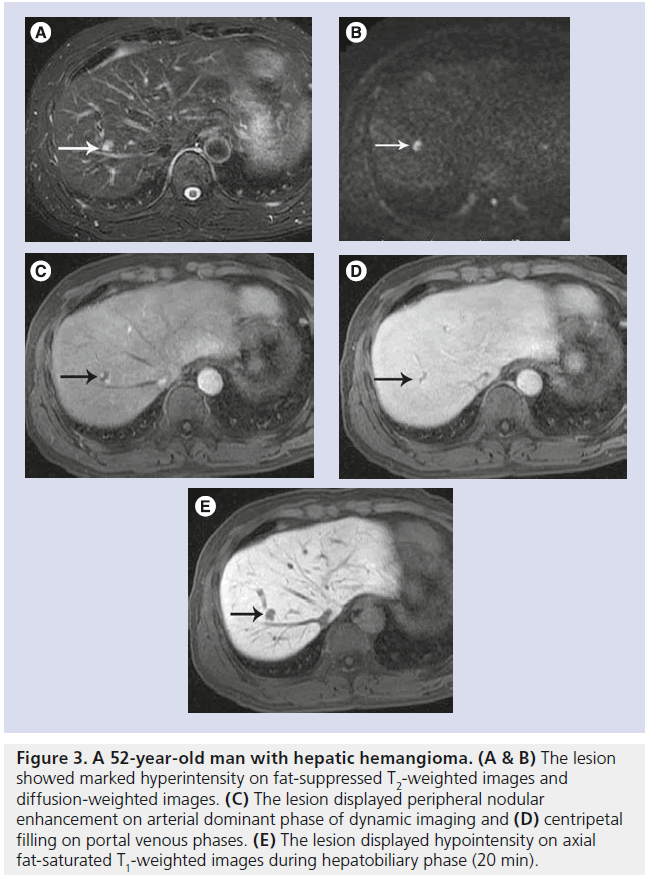 imaging-in-medicine-hepatic-hemangioma