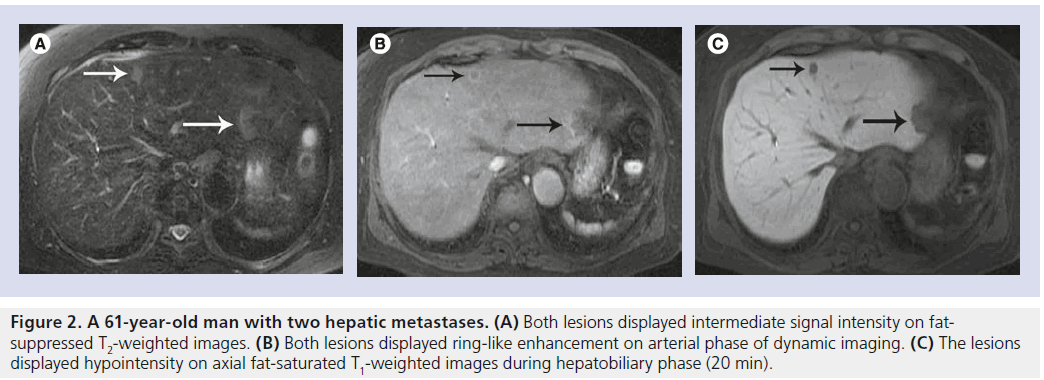 imaging-in-medicine-hepatic-metastases