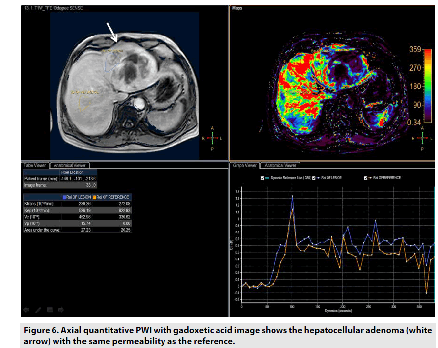 imaging-in-medicine-hepatocellular-adenoma