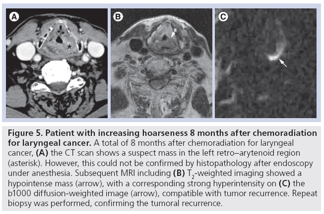 imaging-in-medicine-hoarseness