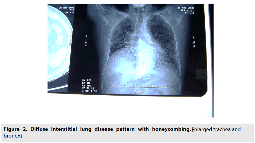 imaging-in-medicine-honeycombing