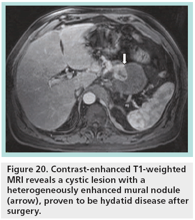 imaging-in-medicine-hydatid-disease