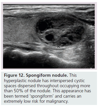 imaging-in-medicine-hyperplastic–nodule