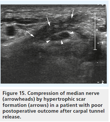 imaging-in-medicine-hypertrophic-scar