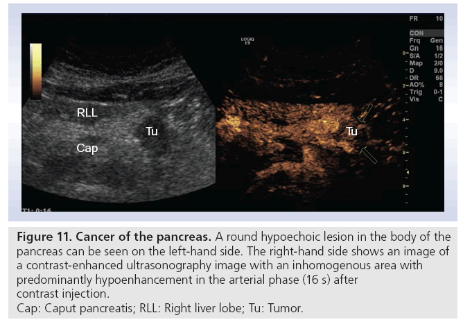 imaging-in-medicine-hypoechoic-lesion