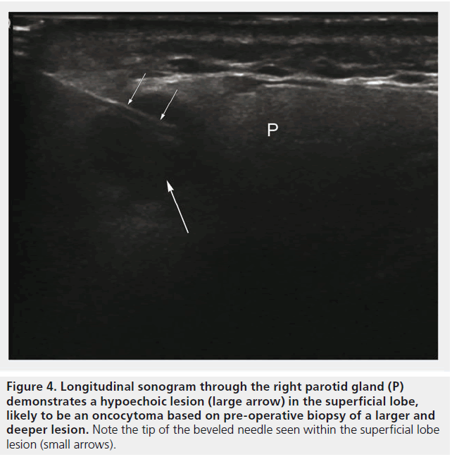 imaging-in-medicine-hypoechoic-lesion