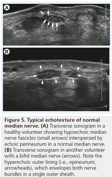 imaging-in-medicine-hypoechoic-median