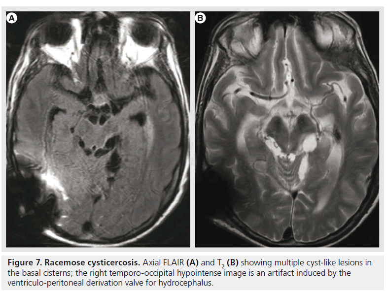 imaging-in-medicine-hypointense-image