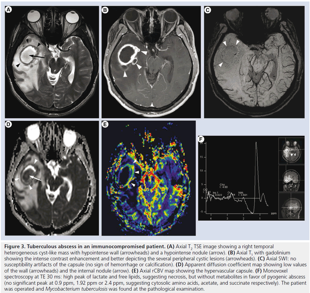 imaging-in-medicine-hypointense-nodule