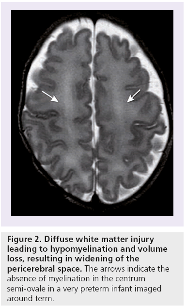 imaging-in-medicine-hypomyelination