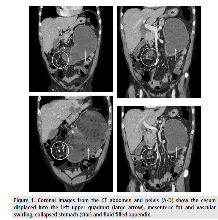 medical case report volvulus