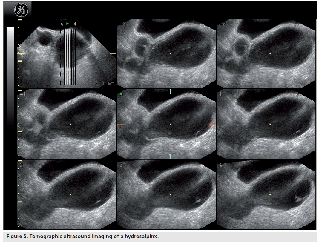 imaging-in-medicine-imaging-hydrosalpinx