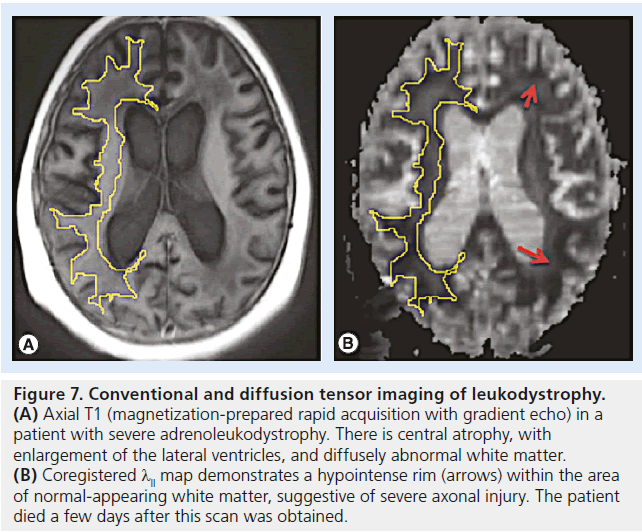 imaging-in-medicine-imaging-leukodystrophy