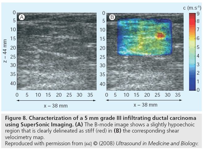 imaging-in-medicine-infiltrating-ductal