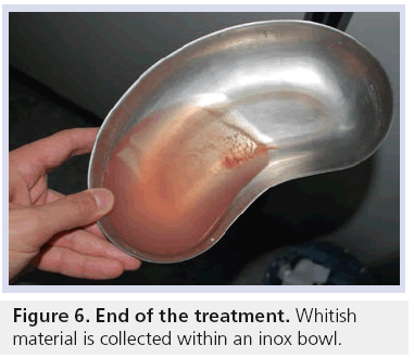 imaging-in-medicine-inox-bowl