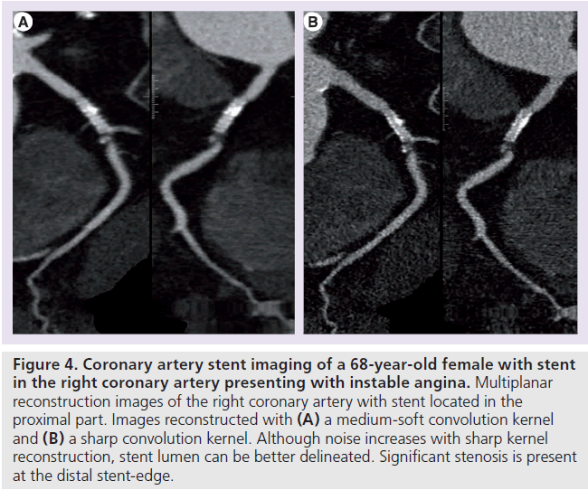 imaging-in-medicine-instable-angina