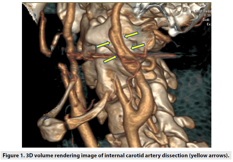 imaging-in-medicine-internal-carotid