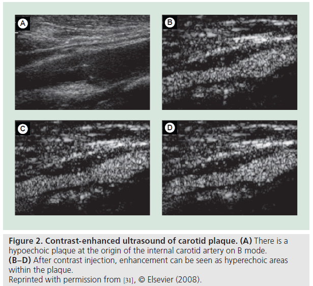 imaging-in-medicine-internal-carotid