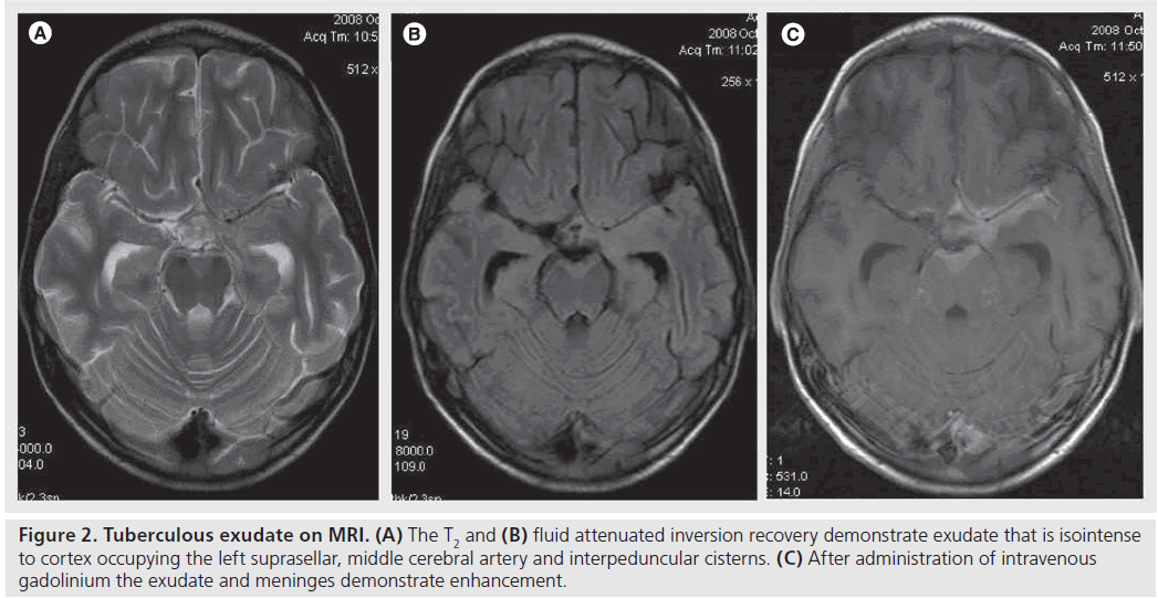 imaging-in-medicine-interpeduncular-cisterns