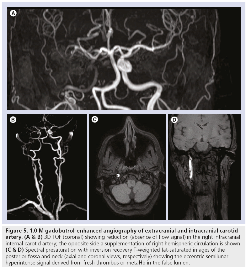 imaging-in-medicine-intracranial-carotid