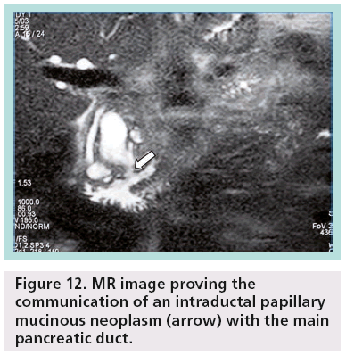 imaging-in-medicine-intraductal-papillary