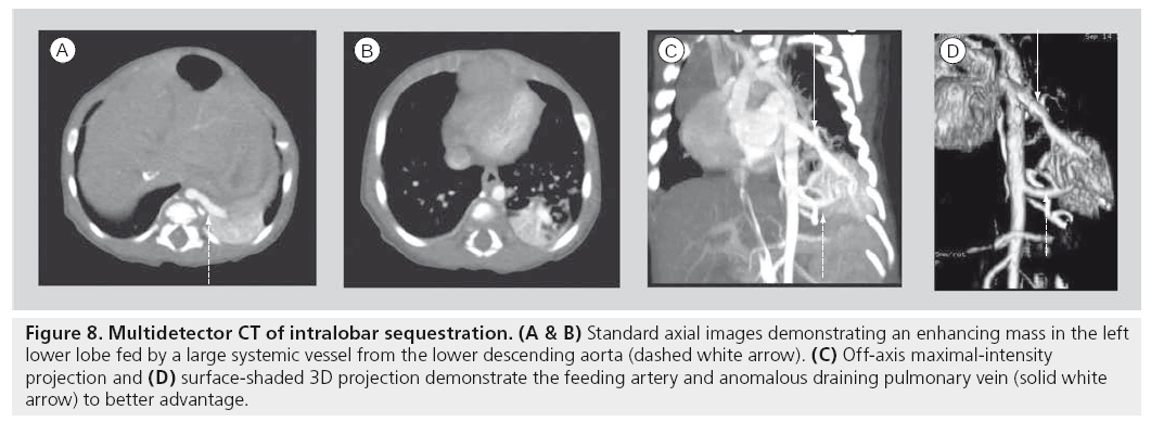 imaging-in-medicine-intralobar-sequestration