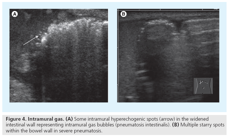 imaging-in-medicine-intramural-hyperechogenic