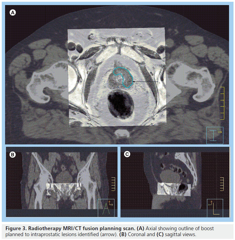 imaging-in-medicine-intraprostatic-lesions