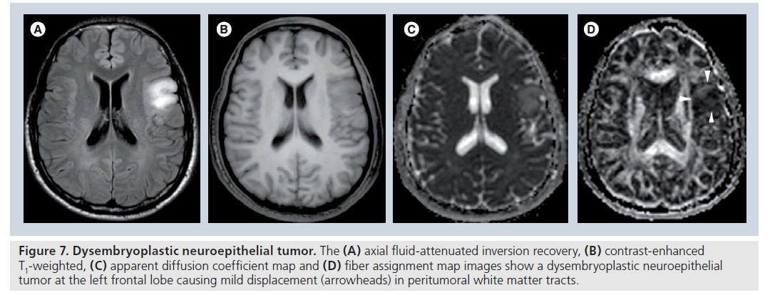 imaging-in-medicine-inversion-recovery