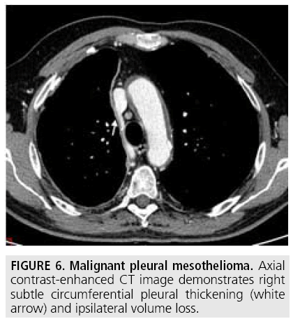 mesothelioma thoracentesis