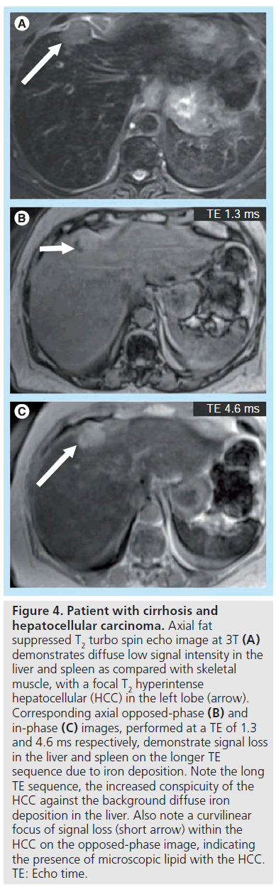imaging-in-medicine-iron-deposition