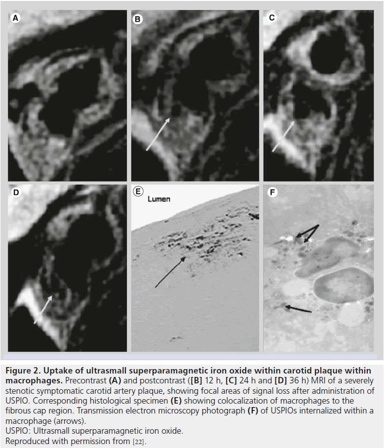imaging-in-medicine-iron-oxide