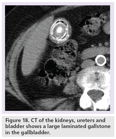 imaging-in-medicine-laminated-gallstone