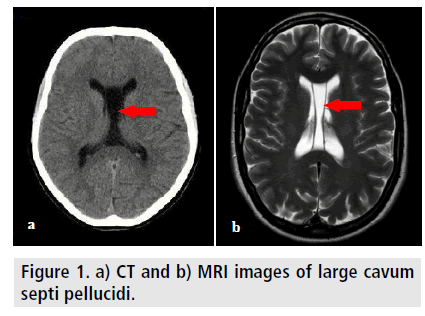 imaging-in-medicine-large-cavum